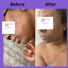 Load image into Gallery viewer, Bar Hyperpigmentation